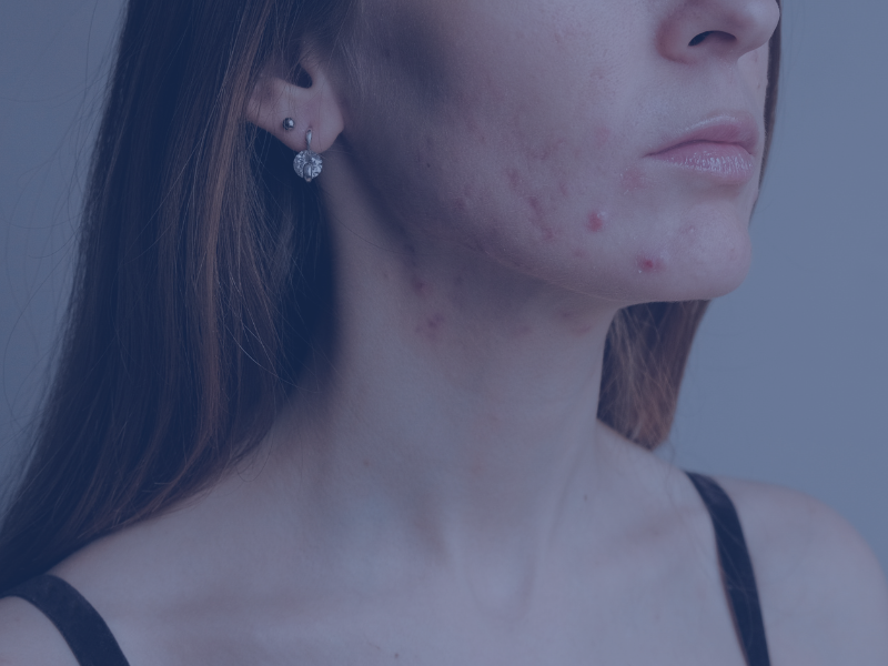 acne adultos