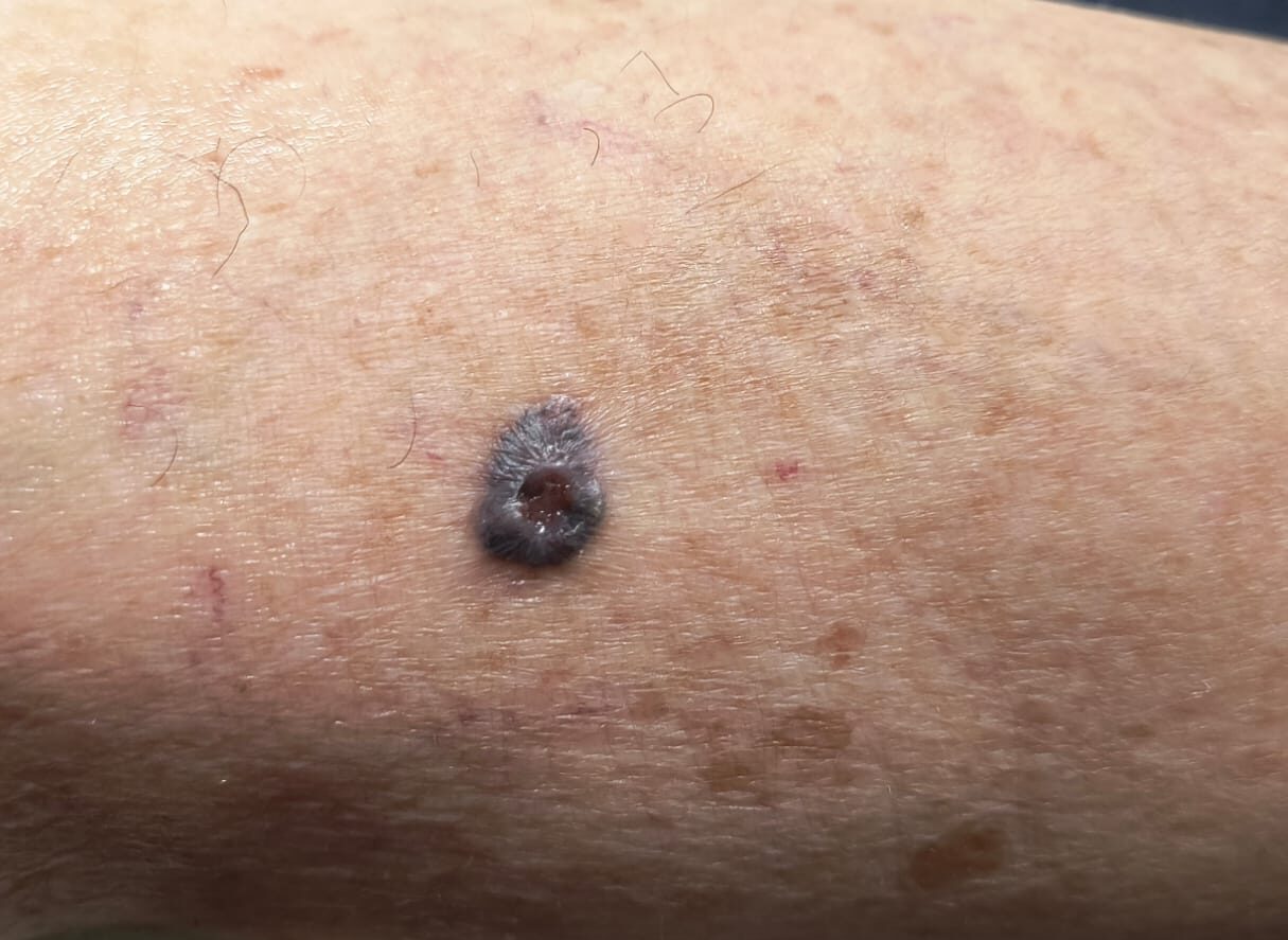 imagen clínica de carcinoma basocelular