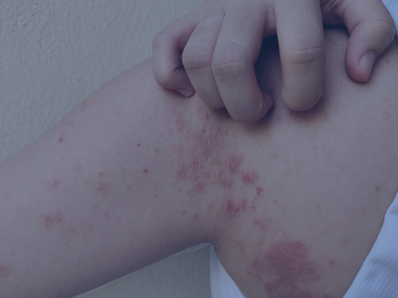 sintomas dermatitis atopica