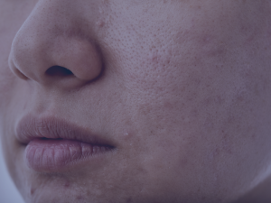 acne mujer adulta