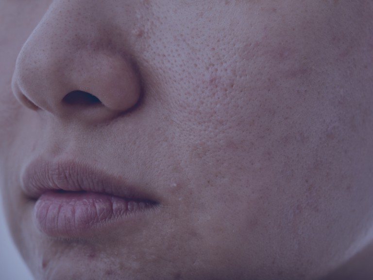 acne mujer adulta