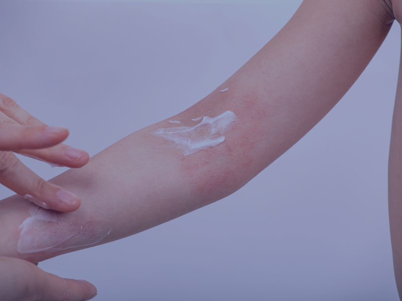 dermatitis atopica