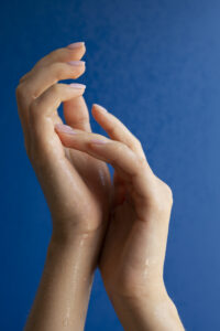 Manos con hiperhidrosis palmar mostrando sudor visible en las palmas.