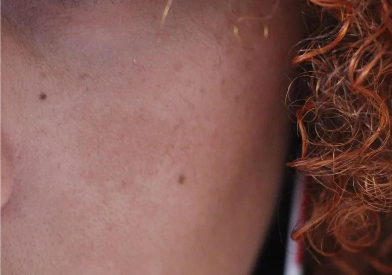 Primer plano de la mejilla de una persona con manchas en la piel del rostro, junto a su pelo rizado pelirrojo