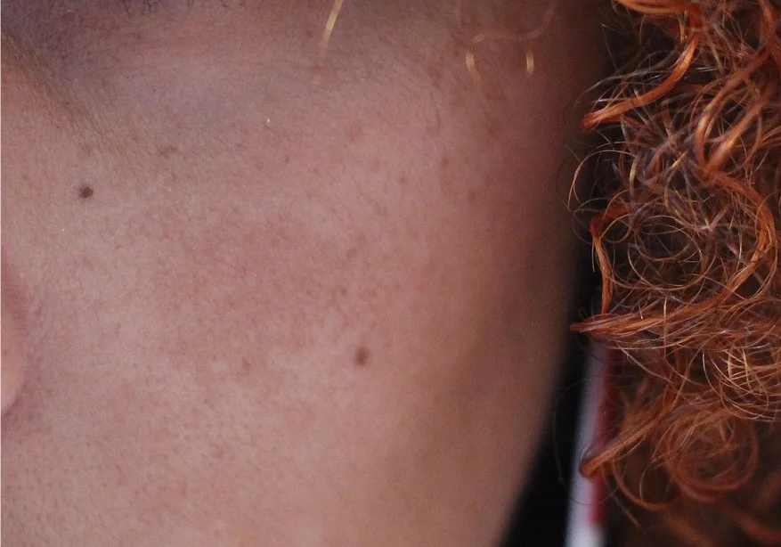 Primer plano de la mejilla de una persona con manchas en la piel del rostro, junto a su pelo rizado pelirrojo